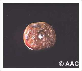 Pourriture sclrotique